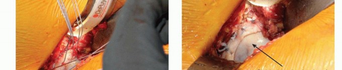 Illustration 36 for Anterior FAI Relief: Mini-Open Anterior Approach Explained