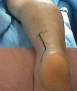 Illustration 16 for Talar Neck Fracture Treatment: Optimizing Recovery with ORIF