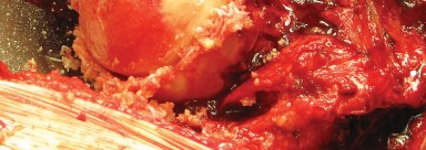 Illustration 42 for Figure Hip Resurfacing: Who Benefits and Who Should Avoid It?