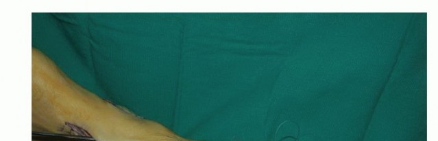 Illustration 33 for Foot Drop Surgery: How a Pin or Drill Elevates Tendon Transfer