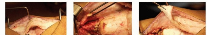Distal Femoral Osteotomy for Crouch Gait: Achieve Full Extension