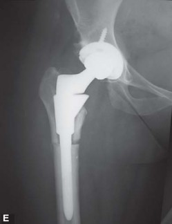 Illustration 156 for Successful Total Hip Replacement in Developmental Dysplasia