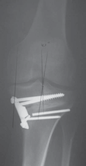Illustration 52 for Guide Pin Assembly: Key to Flawless Upper Tibial Osteotomy