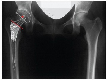 Illustration 3 for Why Double-Tapered Primary Stems Deliver Lasting Stability