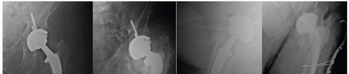 Illustration 3 for Mastering Fixation of Periprosthetic Fractures of the Femur