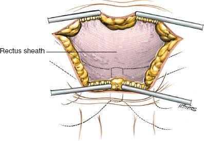 Illustration 7 for Mastering the Posterior Iliac Crest for Bone Graft Harvest