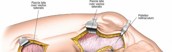 Illustration 53 for Optimal Femoral Approaches: Mastering the Lateral Intermuscular Septum