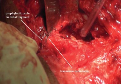Illustration 38 for THA for patients with proximal femoral deformity: Practical solutions