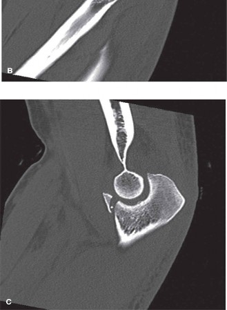 Illustration 2 for Terrible Triad Injury: Expert Guide to Diagnosis & Treatment