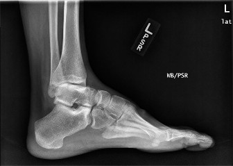 Foot & Ankle Cases: When to Consider a Strong Anterior Tibialis
