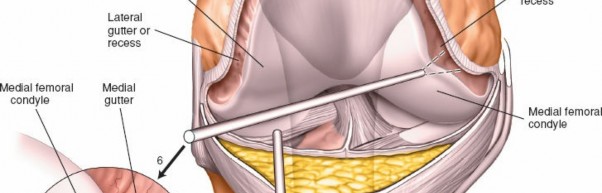 Illustration 12 for Mastering Knee Arthroscopy Approaches: Safely Withdraw the Arthroscope