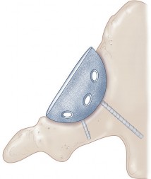 Illustration 46 for Mastering the Cementless Acetabular Cup: Techniques for Optimal Fixation