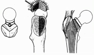 Illustration 27 for Sliding Trochanteric Osteotomy: Modern Role & Refined Techniques