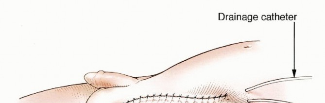 Illustration 32 for Mastering Hip Disarticulation: Through the Hip Joint Capsule