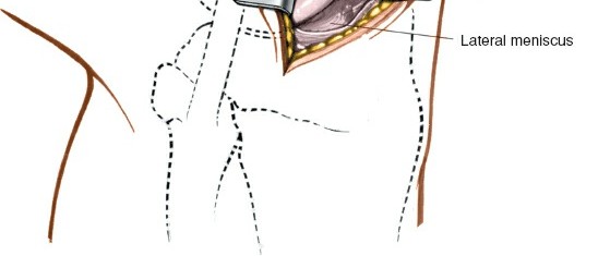 Illustration 140 for Mastering Knee Approaches: Spotlight on Superficial Medial Ligament