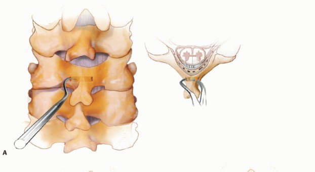 Illustration 6 for Achieve Stability: Posterior Cervical Lateral Mass Screw Fusion
