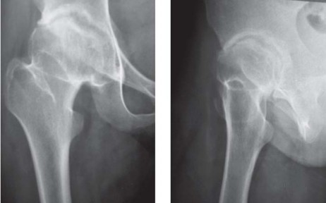 Illustration 41 for Considering METHA Short Stem? Discover Bone-Preserving THA