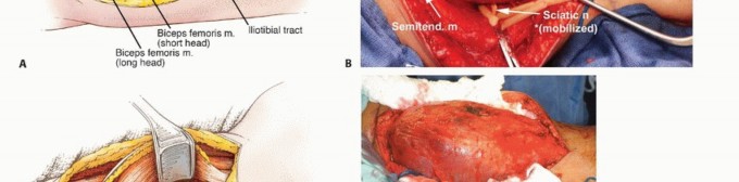 Illustration 12 for Posterior Thigh Resection: Rethinking Outcomes & Limb Sparing