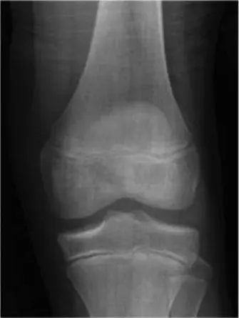 صورة توضيحية لـ كسر صفيحة النمو المعقد في كاحل الأطفال: دليل شامل للعلاج والتعافي مع الأستاذ الدكتور محمد هطيف