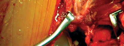 Illustration 69 for Cemented Component Longevity: The Critical Margin of the Acetabulum