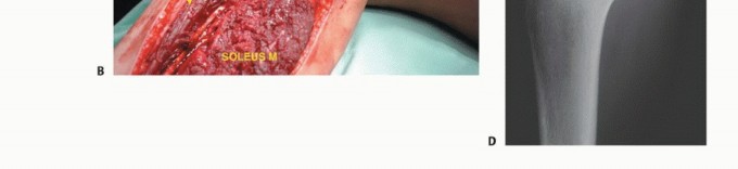 Illustration 27 for Beyond Amputation: The Type I Resection in Fibular Tumor Surgery