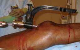 Illustration 53 for Optimal Nailing of the Tibia: Techniques for Challenging Fractures