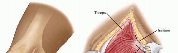 Illustration 49 for Surgical Approaches to Shoulder & Elbow: Pearls and Pitfalls