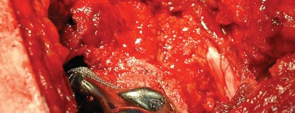 Illustration 111 for Femoral Stem Revision: Posterior Approach for Better Outcomes