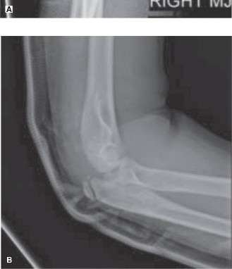 Illustration 2 for Deciphering Flexor Carpi Radialis Injuries in Pediatric Cases