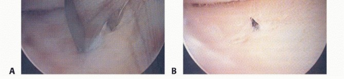 Illustration 46 for Dissecans of the Knee: What's the Difference – OCD vs. AVN?