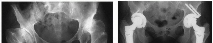 Illustration 4 for Recreate Hip Biomechanics: Modular Stems for Modular Solutions