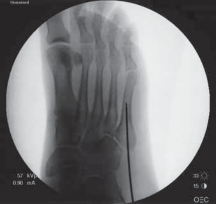 Mastering Jones Fracture Fixation: Open Reduction & Internal Fixation