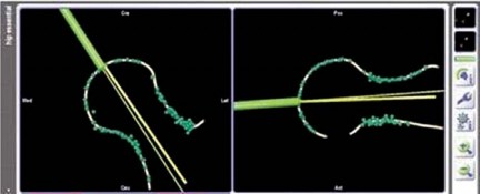 Illustration 39 for Minimizing Risks: Computer Navigation in Hip Resurfacing Arthroplasty