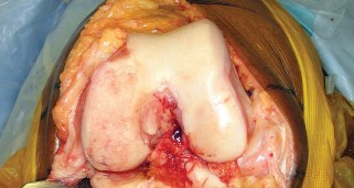 Illustration 6 for Monoblock Total Knee: When to Use & What to Avoid