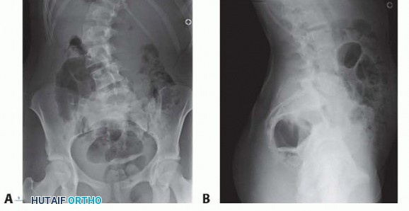 Spinal Fusion for Idiopathic Scoliosis: What to Expect