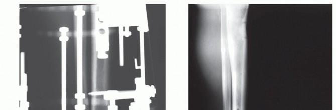 Illustration 23 for Beyond Amputation: Circular Fixation for Infection of the Talus