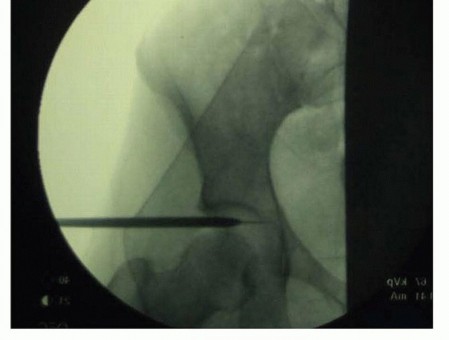 Illustration 19 for Hip Arthroscopy: Your Minimally Invasive Solution for Hip Pain
