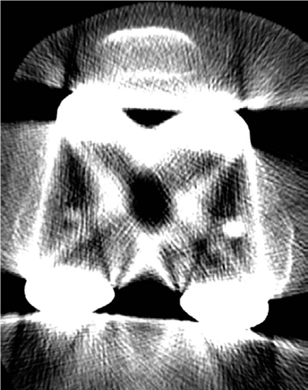 Illustration 2 for TKR Component Malalignment: Oral Examination Question Uncovered