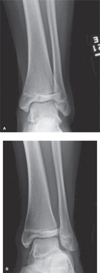 Illustration 6 for 8 Pediatric Cases: Critical Decisions on Exits from the Physis