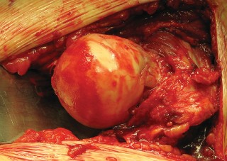 Illustration 30 for Figure Hip Resurfacing: Who Benefits and Who Should Avoid It?