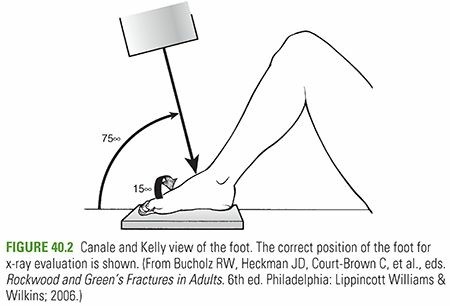 Talus Fractures: Understanding the Talus Bone & Recovery