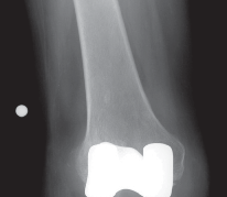 Illustration 45 for PROSTALAC Articulating Spacer: Treat Infected Knees, Regain Mobility