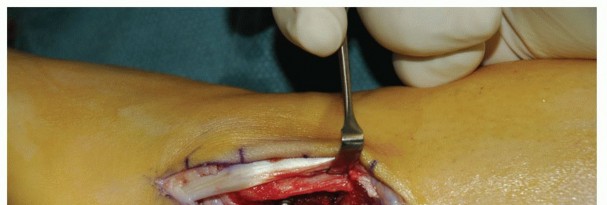 Illustration 23 for Beyond Primary Repair: Solutions for Peroneal Tendon Subluxation