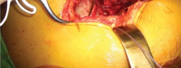 Illustration 92 for Successful Total Hip Replacement in Developmental Dysplasia