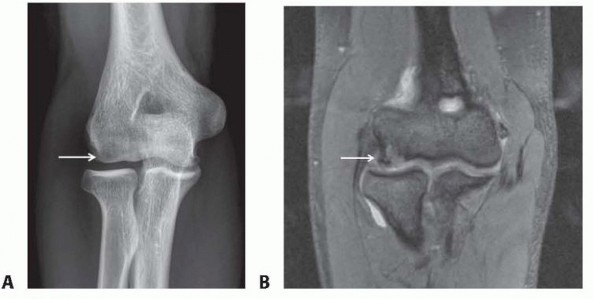 Arthroscopy for Panner: Modern Solutions for Elbow Pain