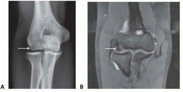 ألم المرفق عند الأطفال والمراهقين: دليل شامل لمرض بانر وتلين العظم الغضروفي والعلاج بمنظار المرفق في اليمن مع د. محمد هطيف