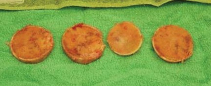 Illustration 15 for Expert Bone Grafting for Primary Total Hip Replacement Success