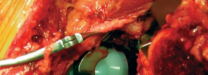 Illustration 64 for Cemented Component Longevity: The Critical Margin of the Acetabulum