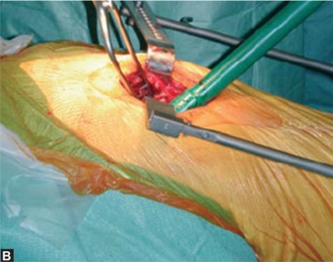 Illustration 6 for Optimizing Acetabular Component Cementation for Superior Outcomes