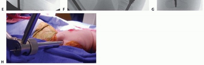 Illustration 23 for Less Pain, More Function: Fassier-Duval Nailing for Osteogenesis Imperfecta